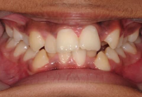 Close-up of a person's mouth showing misaligned and crowded teeth.