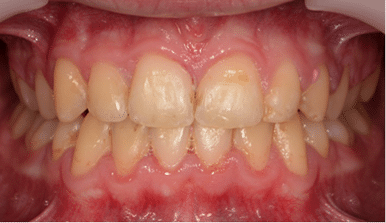Close-up of a person's teeth showing upper and lower dental alignment.