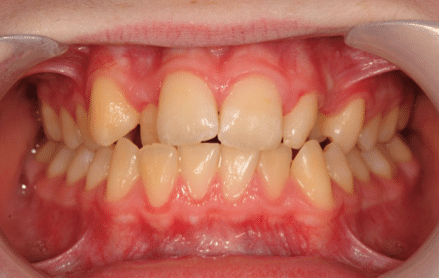 Crooked teeth and gums close-up before orthodontic treatment.