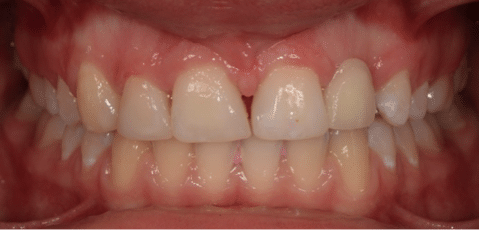 Close-up of human teeth and gums showing dental alignment.