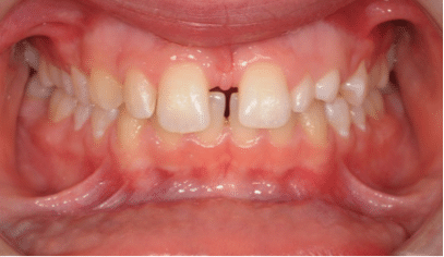 Close-up of a person's mouth showing teeth with a gap between the front teeth.