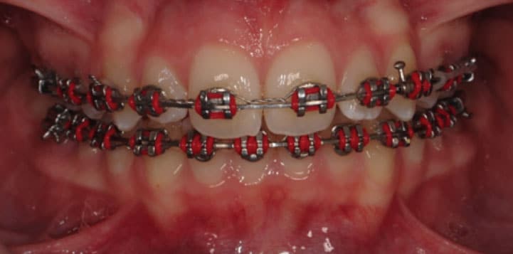 Close-up of teeth with red and silver braces.