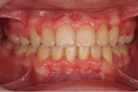 Close-up of a person's upper and lower teeth and gums after dental treatment.