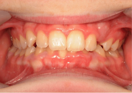 Close-up view of a person's teeth showing overbite and dental misalignment.