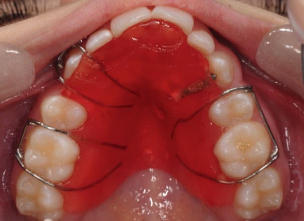 Top view of a person's mouth with a red removable orthodontic appliance fitted onto the upper teeth.