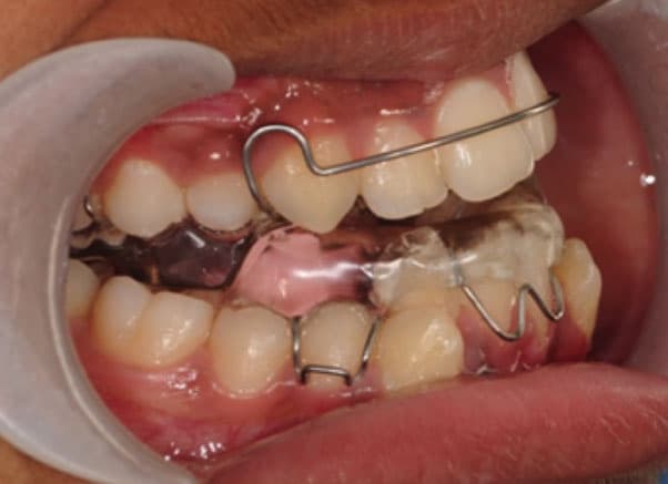 Orthodontic device in mouth showing twin block appliance on teeth.